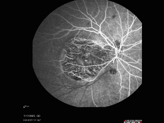 BRAO - plaques in vessels - GIF video of FA
78 year old female with vision loss for 1 week and old macular scar.  Images show BRAO with plaques and FA shows occlusion.
