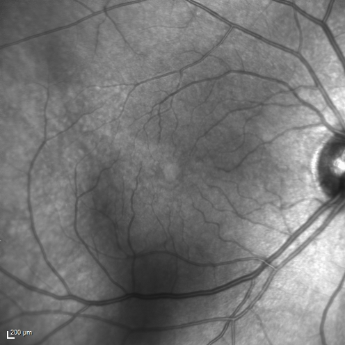 Cystoid Macular Edema 10 years after Cataract Surgery
No overt uveitis but the patient had aching in the eyes and responded to topical anti-inflammatory drops with recurrence of the CME on discontinuation of topical therapy
