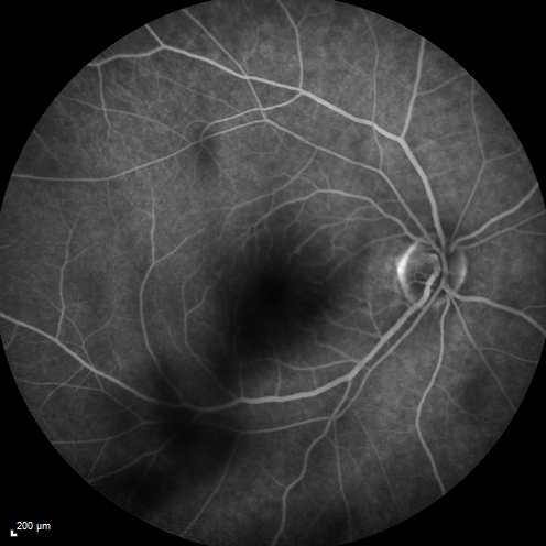 Cystoid Macular Edema 10 years after Cataract Surgery
No overt uveitis but the patient had aching in the eyes and responded to topical anti-inflammatory drops with recurrence of the CME on discontinuation of topical therapy
