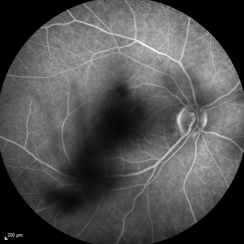 Cystoid Macular Edema 10 years after Cataract Surgery
No overt uveitis but the patient had aching in the eyes and responded to topical anti-inflammatory drops with recurrence of the CME on discontinuation of topical therapy
