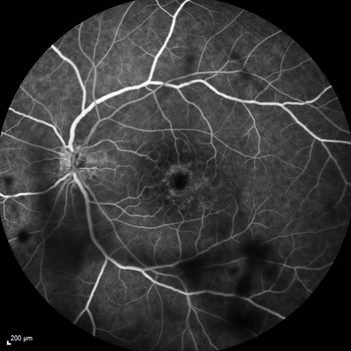 Cystoid Macular Edema 10 years after Cataract Surgery
No overt uveitis but the patient had aching in the eyes and responded to topical anti-inflammatory drops with recurrence of the CME on discontinuation of topical therapy
