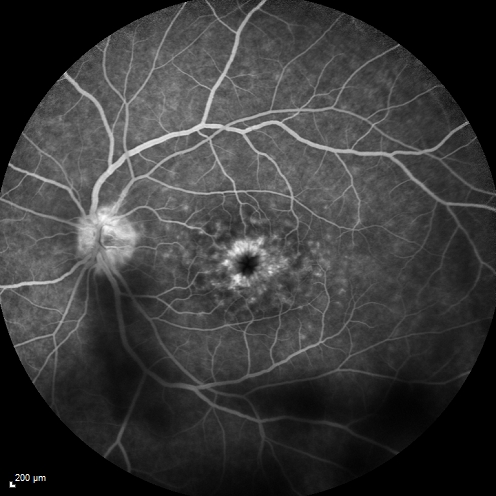 Cystoid Macular Edema 10 years after Cataract Surgery
No overt uveitis but the patient had aching in the eyes and responded to topical anti-inflammatory drops with recurrence of the CME on discontinuation of topical therapy
