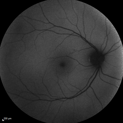 Central retinal artery and vein occlusion - Protein C Deficiency 33 year old male
33 year old male with vision loss for 3 hours.  VA 20/12 right eye, 5/200 left eye.  He has a protein C deficiency.  The left eye recovered vision in about 1 month to 20/16.  FA shows very slow recirculation time.
