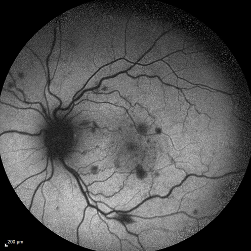 Central retinal artery and vein occlusion - Protein C Deficiency 33 year old male
33 year old male with vision loss for 3 hours.  VA 20/12 right eye, 5/200 left eye.  He has a protein C deficiency.  The left eye recovered vision in about 1 month to 20/16.  FA shows very slow recirculation time.
