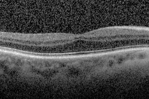 Foveal hypoplasia - aplasia
SD OCT shows persistent plexiform layers in the center of the macula 
EXTENDED HPI: He is having some trouble seeing his gadgets (like his watch). He was diagnosed with morning glory syndrome at about 3 yeras old. This last visit you saw fluid under the retina and asked him to come here. The vision is a little worse.
VA OD: Dcc20/40+2 NccJ2-2
VA OS: Dcc20/25-2 NccJ1-2
