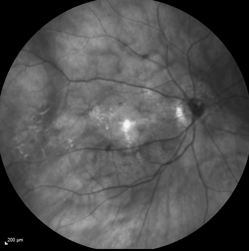 Myopic Traction Maculopathy - Long Term Follow-up
88-92 year old woman with about 20/40 vision and myopic tractional maculopathy.  Her vision fluctuates a little.  The serial OCT's show no progression.
