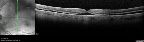 Persistent subfoveal fluid following retinal detachment repair
62 year old man following pneumatic retinopexy for macula-off retinal detachment.  Subfoveal fluid persisted for more than a year.
