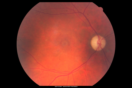 Three years after Injury - Optic Atrophy - Vision is 1/200 in each eye
