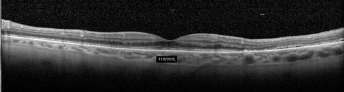 Persistent subfoveal fluid following retinal detachment repair
62 year old man following pneumatic retinopexy for macula-off retinal detachment.  Subfoveal fluid persisted for more than a year.

