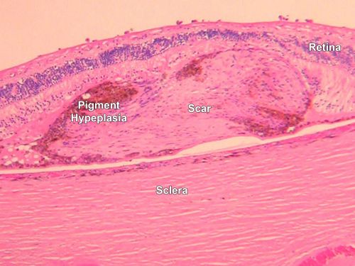 Macular Scar with Retinal Pigment Epithelial Hyperplasia - Hyperpigmentation - Wet Macular Degeneration
Macular Scar in age related macular degeneration with pathology showing retinal pigment epithelial hyperplasia at the edge of the scar.  Histopathogy, microscopic slide, pathology.
