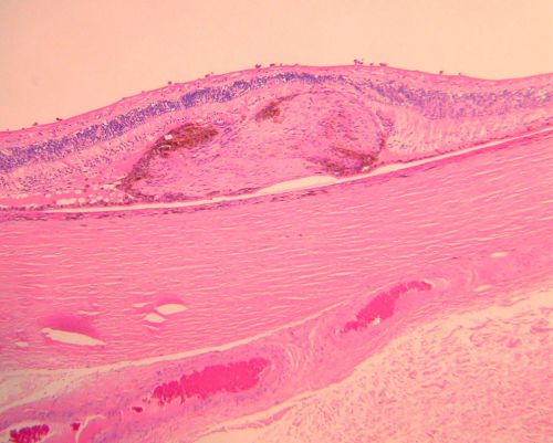 Macular Scar with Retinal Pigment Epithelial Hyperplasia - Hyperpigmentation - Wet Macular Degeneration
Macular Scar in age related macular degeneration with pathology showing retinal pigment epithelial hyperplasia at the edge of the scar.  Histopathogy, microscopic slide, pathology.
