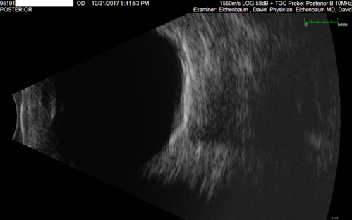 Choroidal Osteoma - 13 year old - Good Vision 20-40 - B-scan Ultrasound
