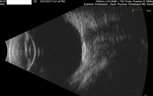 Choroidal Osteoma - 13 year old - Good Vision 20-40 - B-scan Ultrasound
