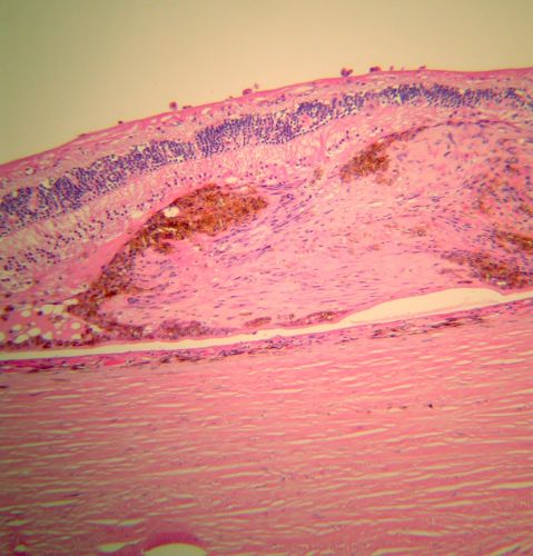 Macular Scar with Retinal Pigment Epithelial Hyperplasia - Hyperpigmentation - Wet Macular Degeneration
Macular Scar in age related macular degeneration with pathology showing retinal pigment epithelial hyperplasia at the edge of the scar.  Histopathogy, microscopic slide, pathology.
