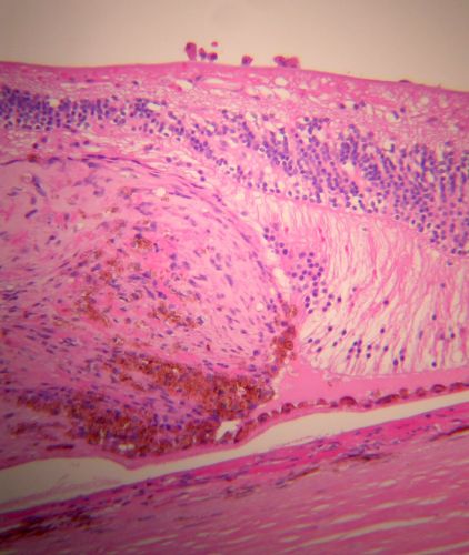 Macular Scar with Retinal Pigment Epithelial Hyperplasia - Hyperpigmentation - Wet Macular Degeneration
Macular Scar in age related macular degeneration with pathology showing retinal pigment epithelial hyperplasia at the edge of the scar.  Histopathogy, microscopic slide, pathology.
