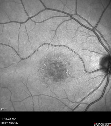ABCA4 positive - Stargardt Disease
24 year old female She has worn glasses since she was a kid.  Since she became an adult her vision started to deteriorate more rapidly.  This seems to have been happening since she entered the accounting department for the last two years.  Her vision is worse in the light especially when she is driving.  She can see green lights in the night but not in the day.  She sees better on a dark background than on a light background. 
Her mother and father both have inherited retinal diseases.  His mother was diagnosed 23 years ago with Stargardts genetically confirmed in Boston.  The father has Retinitis Pigmentosa.  The mother has seven brothers and sisters and four have Stargardts and they are legally blind.  Also one cousin has it.

PMHx benign, Meds: vitamins.
VA OD: Dcc20/160
VA OS: Dcc20/160
IOP: TP: OD:20 OS:21

