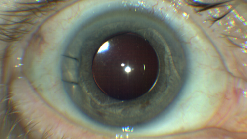 Upside Down Lens Syndrome - Anterior Chamber IOL Upside Down
77 year old female who had vitrectomy for retained lens fragments and has had difficulty with recurrent uveitis since her cataract surgery.  The anterior chamber intraocular lens is upside down.  A lens exchange is planned.
