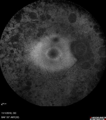 Retinitis Pigmentosa - Autosomal Dominant - Good Vision
55 year old female was diagnosed in 1990 with RP and the vision has been stable for the last 10 years.  Her mother and her two brothers and her grandmother and the patient and her two sisters all have confirmed RP.  No one has been tested. VA 20/25 OU
