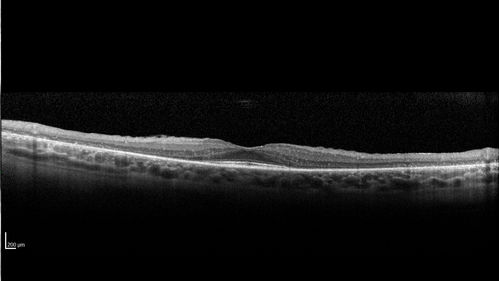 Retinitis Pigmentosa - Autosomal Dominant - Good Vision
55 year old female was diagnosed in 1990 with RP and the vision has been stable for the last 10 years.  Her mother and her two brothers and her grandmother and the patient and her two sisters all have confirmed RP.  No one has been tested. VA 20/25 OU
