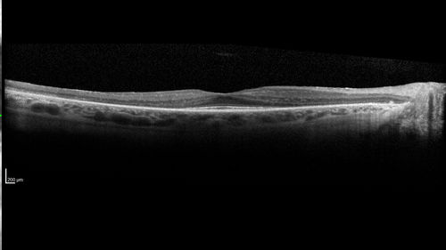 Retinitis Pigmentosa - Autosomal Dominant - Good Vision
55 year old female was diagnosed in 1990 with RP and the vision has been stable for the last 10 years.  Her mother and her two brothers and her grandmother and the patient and her two sisters all have confirmed RP.  No one has been tested. VA 20/25 OU
