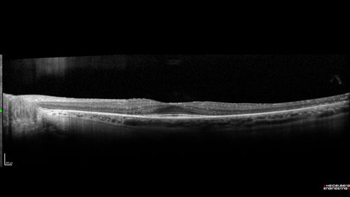 Retinitis Pigmentosa - Autosomal Dominant - Good Vision
55 year old female was diagnosed in 1990 with RP and the vision has been stable for the last 10 years.  Her mother and her two brothers and her grandmother and the patient and her two sisters all have confirmed RP.  No one has been tested. VA 20/25 OU
