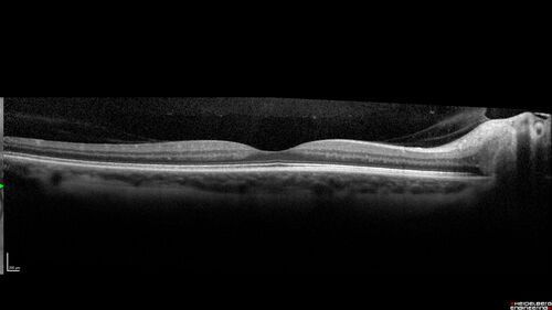 Ischemic Optic Neuropathy associated with GLP-1 Agonist
48 year old female woke up with blurry vision inferiorly in the right eye. the right optic nerve isnoted to be swollen. She does not have any pain with eye movements. The left eye is OK.
Medical History: Migraines
Surgical History: LASIK OU (2006) 
Systemic Meds: Mounjaro (tirzepatide) injection qweekly since 8/2024, Prozac, Nexium, Sumatriptan. 
VA OD: Dcc 20/20
VA OS: Dcc 20/16-1
