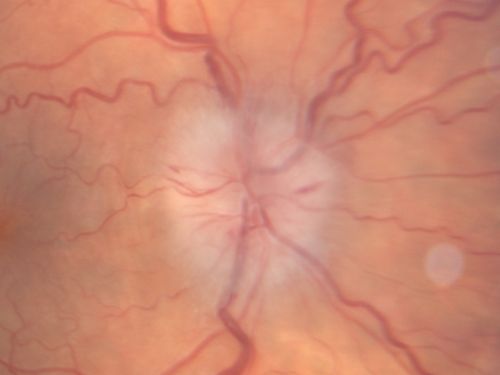 Anterior Ischemic Optic Neuropathy - Non-Arteritic - AION
72-year-old woman  sudden vision loss in the right eye about four days ago.  She also has noticed that things are dim out of that eye.  She has no headaches.  She does feel a little tired.  She has no pain in her jaw when she chews and she has no fevers.  
OD is 20/80, PH 20/25; OS is 20/25
