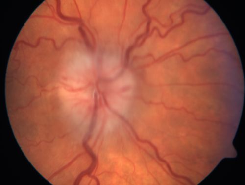 Anterior Ischemic Optic Neuropathy - Non-Arteritic - AION
72-year-old woman  sudden vision loss in the right eye about four days ago.  She also has noticed that things are dim out of that eye.  She has no headaches.  She does feel a little tired.  She has no pain in her jaw when she chews and she has no fevers.  
OD is 20/80, PH 20/25; OS is 20/25
