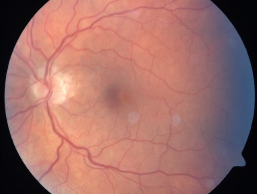 Anterior Ischemic Optic Neuropathy - Non-Arteritic - AION
72-year-old woman  sudden vision loss in the right eye about four days ago.  She also has noticed that things are dim out of that eye.  She has no headaches.  She does feel a little tired.  She has no pain in her jaw when she chews and she has no fevers.  
OD is 20/80, PH 20/25; OS is 20/25
