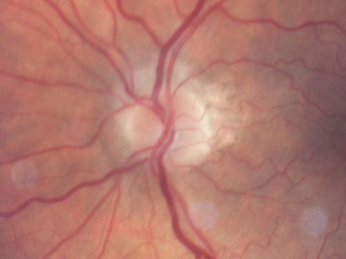 Anterior Ischemic Optic Neuropathy - Non-Arteritic - AION
72-year-old woman  sudden vision loss in the right eye about four days ago.  She also has noticed that things are dim out of that eye.  She has no headaches.  She does feel a little tired.  She has no pain in her jaw when she chews and she has no fevers.  
OD is 20/80, PH 20/25; OS is 20/25
