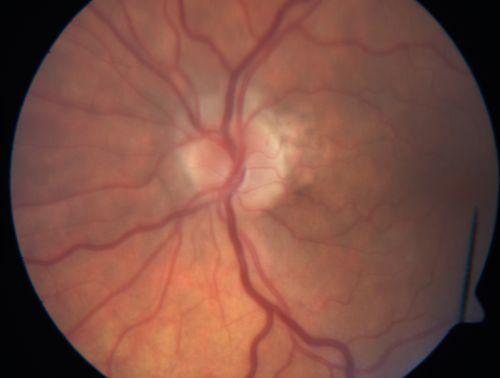 Anterior Ischemic Optic Neuropathy - Non-Arteritic - AION
72-year-old woman  sudden vision loss in the right eye about four days ago.  She also has noticed that things are dim out of that eye.  She has no headaches.  She does feel a little tired.  She has no pain in her jaw when she chews and she has no fevers.  
OD is 20/80, PH 20/25; OS is 20/25
