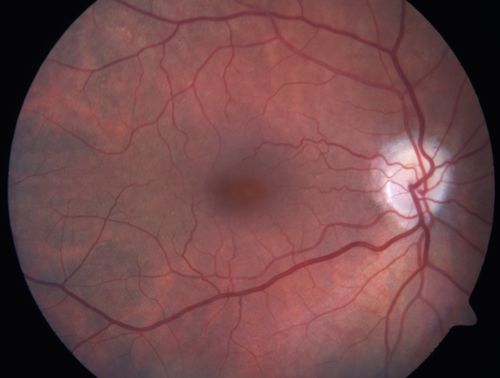 Acute AION OS - Mild disc pallor OD
Sudden vision loss OS x 1 week with optic nerve swelling.  Evidence of optic atrophy in right eye. 
