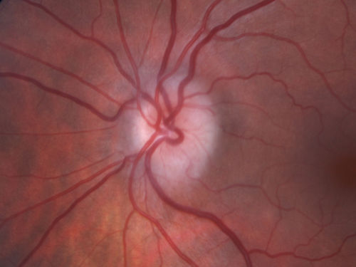 Acute AION OS - Mild disc pallor OD
Sudden vision loss OS x 1 week with optic nerve swelling.  Evidence of optic atrophy in right eye. 
