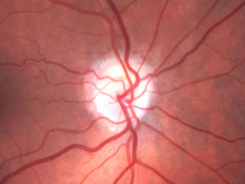 Acute AION OS - Mild disc pallor OD
Sudden vision loss OS x 1 week with optic nerve swelling.  Evidence of optic atrophy in right eye. 
