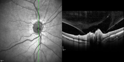 Acute AION OS - Mild disc pallor OD
Sudden vision loss OS x 1 week with optic nerve swelling.  Evidence of optic atrophy in right eye. 
