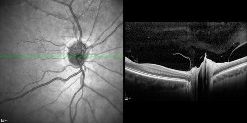 Acute AION OS - Mild disc pallor OD
Sudden vision loss OS x 1 week with optic nerve swelling.  Evidence of optic atrophy in right eye. 
