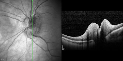 Acute AION OS - Mild disc pallor OD
Sudden vision loss OS x 1 week with optic nerve swelling.  Evidence of optic atrophy in right eye. 
