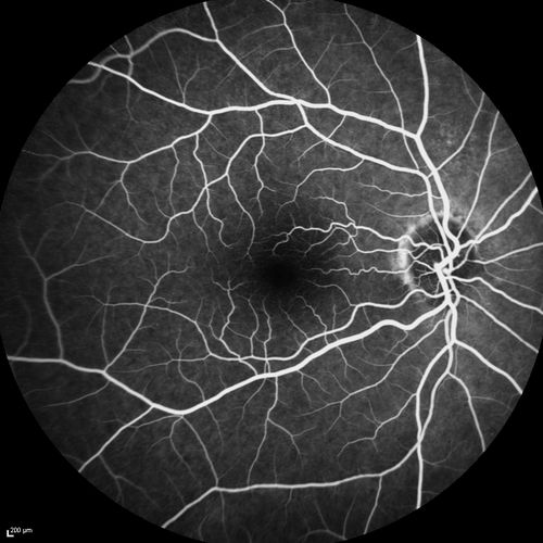 Acute AION OS - Mild disc pallor OD
Sudden vision loss OS x 1 week with optic nerve swelling.  Evidence of optic atrophy in right eye. 
