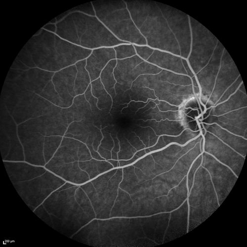 Acute AION OS - Mild disc pallor OD
Sudden vision loss OS x 1 week with optic nerve swelling.  Evidence of optic atrophy in right eye. 
