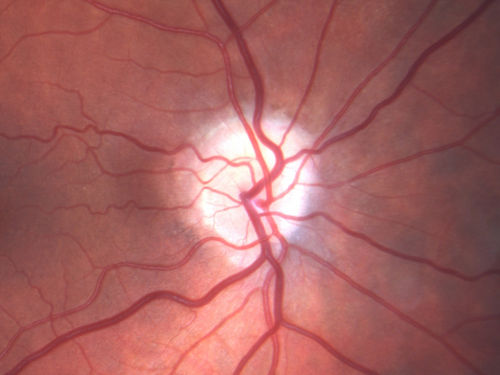 Acute AION OS - Mild disc pallor OD
Sudden vision loss OS x 1 week with optic nerve swelling.  Evidence of optic atrophy in right eye. 

