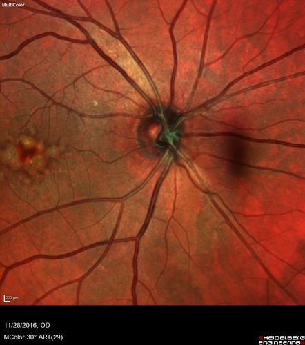 Confluent Soft Drusen with Subetinal Fluid - Right Eye
Asymptomatic 85 year old man.  OCT shows pocket of subfoveal fluid in the center of the macula.  This could be mechanical from the drusen preventing the retina from settling down.  Testing did not reveal a CNVM and subsequent OCT 6 weeks later showed no change in structure.
