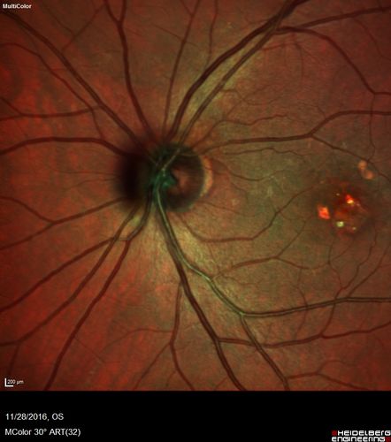 Confluent Soft Drusen with Subetinal Fluid - Right Eye
Asymptomatic 85 year old man.  OCT shows pocket of subfoveal fluid in the center of the macula.  This could be mechanical from the drusen preventing the retina from settling down.  Testing did not reveal a CNVM and subsequent OCT 6 weeks later showed no change in structure.
