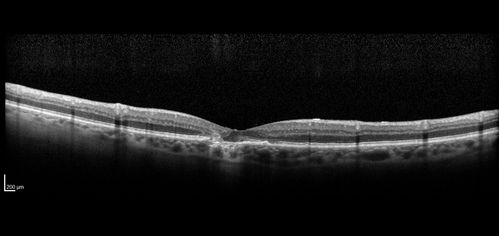 Confluent Soft Drusen with Subetinal Fluid - Right Eye
Asymptomatic 85 year old man.  OCT shows pocket of subfoveal fluid in the center of the macula.  This could be mechanical from the drusen preventing the retina from settling down.  Testing did not reveal a CNVM and subsequent OCT 6 weeks later showed no change in structure.
