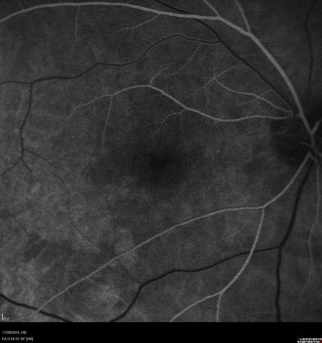 Confluent Soft Drusen with Subetinal Fluid - Right Eye
Asymptomatic 85 year old man.  OCT shows pocket of subfoveal fluid in the center of the macula.  This could be mechanical from the drusen preventing the retina from settling down.  Testing did not reveal a CNVM and subsequent OCT 6 weeks later showed no change in structure.
