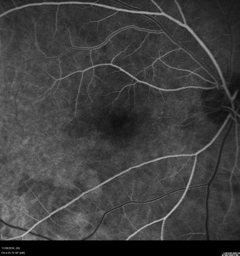 Confluent Soft Drusen with Subetinal Fluid - Right Eye
Asymptomatic 85 year old man.  OCT shows pocket of subfoveal fluid in the center of the macula.  This could be mechanical from the drusen preventing the retina from settling down.  Testing did not reveal a CNVM and subsequent OCT 6 weeks later showed no change in structure.
