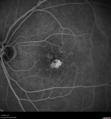 Confluent Soft Drusen with Subetinal Fluid - Right Eye
Asymptomatic 85 year old man.  OCT shows pocket of subfoveal fluid in the center of the macula.  This could be mechanical from the drusen preventing the retina from settling down.  Testing did not reveal a CNVM and subsequent OCT 6 weeks later showed no change in structure.
