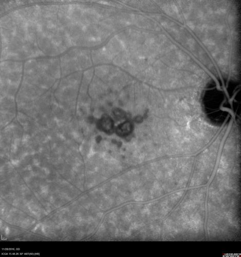 Confluent Soft Drusen with Subetinal Fluid - Right Eye
Asymptomatic 85 year old man.  OCT shows pocket of subfoveal fluid in the center of the macula.  This could be mechanical from the drusen preventing the retina from settling down.  Testing did not reveal a CNVM and subsequent OCT 6 weeks later showed no change in structure.
