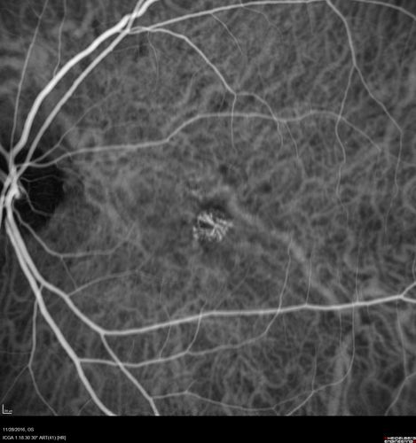 Confluent Soft Drusen with Subetinal Fluid - Right Eye
Asymptomatic 85 year old man.  OCT shows pocket of subfoveal fluid in the center of the macula.  This could be mechanical from the drusen preventing the retina from settling down.  Testing did not reveal a CNVM and subsequent OCT 6 weeks later showed no change in structure.
