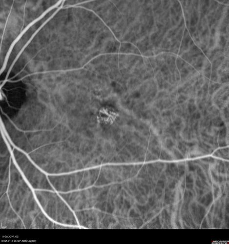 Confluent Soft Drusen with Subetinal Fluid - Right Eye
Asymptomatic 85 year old man.  OCT shows pocket of subfoveal fluid in the center of the macula.  This could be mechanical from the drusen preventing the retina from settling down.  Testing did not reveal a CNVM and subsequent OCT 6 weeks later showed no change in structure.
