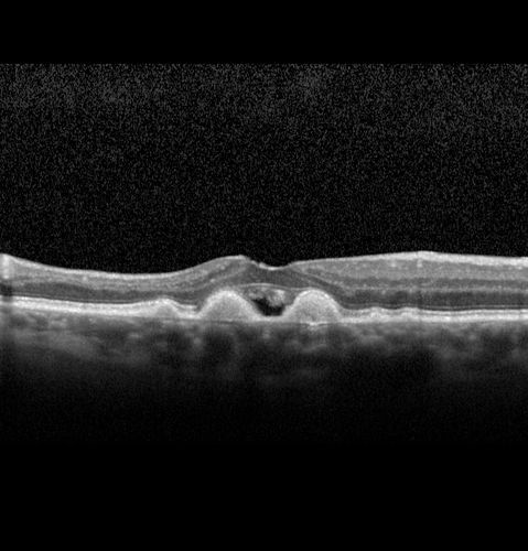 Confluent Soft Drusen with Subetinal Fluid - Right Eye
Asymptomatic 85 year old man.  OCT shows pocket of subfoveal fluid in the center of the macula.  This could be mechanical from the drusen preventing the retina from settling down.  Testing did not reveal a CNVM and subsequent OCT 6 weeks later showed no change in structure.
